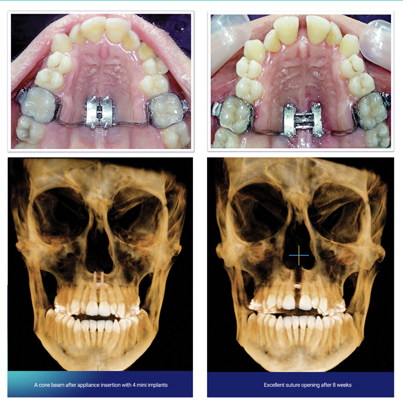 MARPE case before and After IOS 