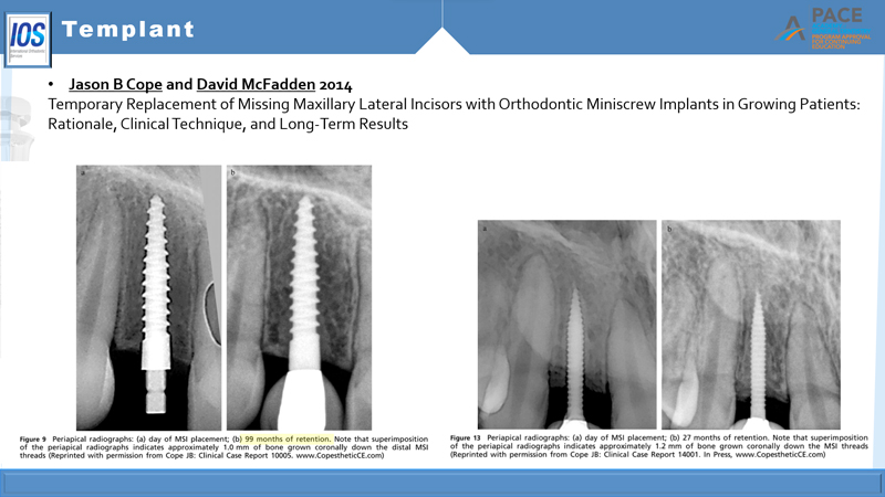 temporary dental Implant