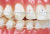 Picture of Tooth Colored Open Coil NiTi .010 × .036 - 7" - Tube/7"